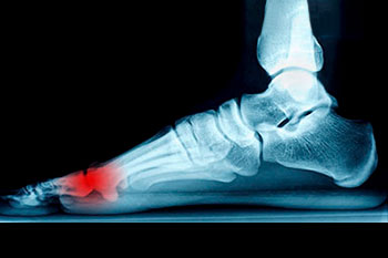 neuromas